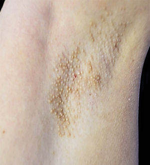 Fox-Fordyce Disease. Case 1. Yellowish-brown punctate papules with follicular distribution coalescing in plaques and affecting both armpits