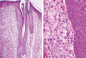 Fox-Fordyce Disease. A. Histological section with infundibular dilation and corneal plug (Hematoxylin & eosin, x10) B. Higher magnification of xanthomatous peri-infundibular cells (Hematoxylin & eosin, x40)