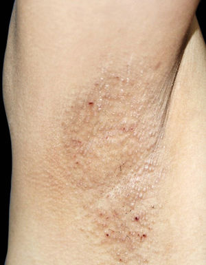 Fox-Fordyce Disease. Case 2. Punctate papules with follicular distribution in the armpits and hemorrhagic crusts due to scratching
