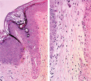 Fox-Fordyce Disease. A - Histological section with characteristic corneal plug and lymphohistiocytic inflammatory perifollicular infiltrate (Hematoxylin & eosin, x20) B - Higher magnification of peri-infundibular cells with xanthomatous aspect (Hematoxylin & eosin, x40)