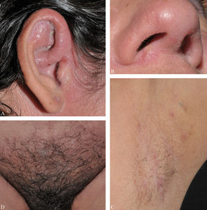 Lesions of amicrobial pustulosis of the folds. A - Edema, erythema, pustules and ulcerations on the pinna; B - Erythema, crusts and fissures on the nostrils; C - Papules and pustules in the axillary cavity; D - Diffuse erythema and pustules in the pubic region