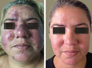 Facial lesions of demodicosis before and after treatment. A - Evident worsening of the facial lesions, with infiltration of the malar regions and increase in the number of pustules; B - Evident regression of the lesions after four weeks of acaricidal treatment