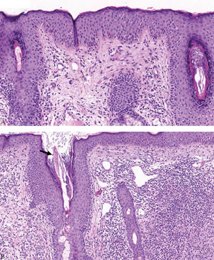 Histopathological exam of facial papular lesion) A - Hyperkeratosis with follicular plugs and granulomatous foci; B - Infundibular dilation with Demodex spp. (arrow) and associated folliculitis (Hematoxylin & eosin, x40)