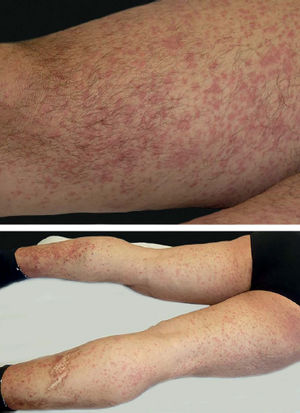 Severe itching papular-purpuric eruptions on the skin of the patient
