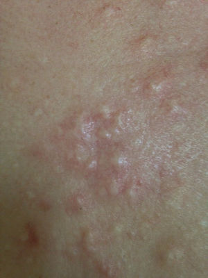 Normochromic, confluent papules with erythematous borders