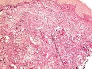 Areas with thickening of dermal connective bundles and reduced number of elastic fibers, which are thin and fragmented (Weigert, x20)