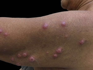 Erythematous papules and nodules, some with a target-like aspect, on the left arm
