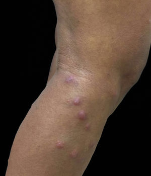 Erythematous papules and nodules on the right leg