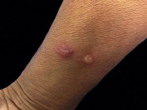 Erythematous plaque and nodule with pseudo-vesicular aspect on the right forearm