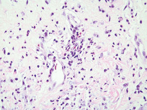 Presence of neutrophils with perivascular distribution (Hematoxylin & eosin, x400)