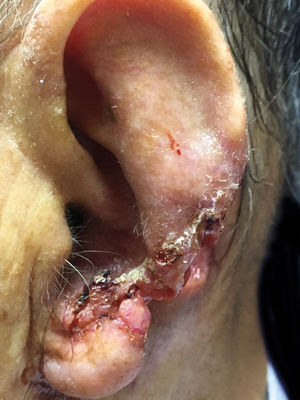 Ulcerated and infiltrating tumor with local destruction of auricular tissue