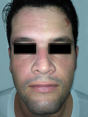 Patient demonstrating flushing and sweating only on the right side of the face following exercise