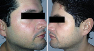 (A) Right side. (B) Loss of flushing and sweating on the left side of the face and forehead