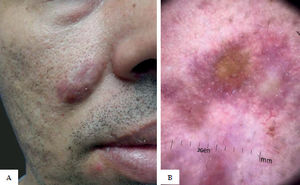 A - Erythematous-violaceous plaque near the right nasolabial fold. B - Yellowish area in the center of the lesion associated to marked follicles, irregular white streaks and background erythema (contact dermoscopy with immersion fluid, x10)