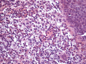 Mixed infiltrate formed by lymphocytes, histiocytes, plasma cells and neutrophils and a grenz zone (Hematoxylin & eosin, x400)