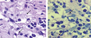 Histopathological examination: A - mixed inflammatory infiltrate and macrophages with ample cytoplasm filled with bacilli (arrows) (Hematoxylin & eosin x400) B - Bacilli containg macrophages (arrows) (Giemsa x400)