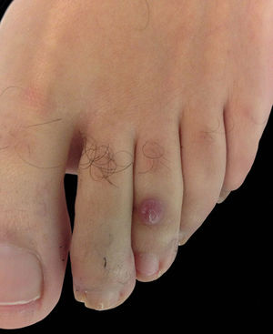 Violaceous nodule on the toe