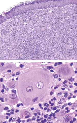 A – Nodular dermal area composed of large histiocytic cells