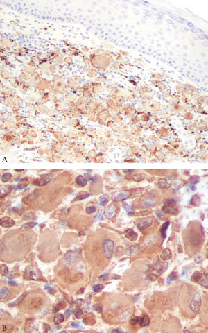 Immunohistochemical staining positive. A – CD68 (x100) and B – Vimentin (x400)
