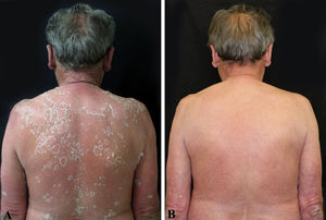 A - Erythrodermic psoriasis with diffuse erythema and scaling. B - Significant improvement after 72 hours of wet wrap therapy