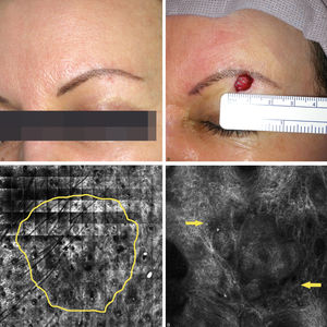 A 50 year-old female patient presenting with erythematous lesion on left brow, with imprecise limits and unspecific vascular pattern on dermatoscopic examination (A). Removal of lesion with additional margin of 2 mm beyond the margins set by confocal microscopy (B). On confocal microscopy, tumor islands and clefts were observed (arrow), suggesting the diagnosis of basal cell carcinoma with approximate 5 x 4.5mm on long axis dimensions (C and D)