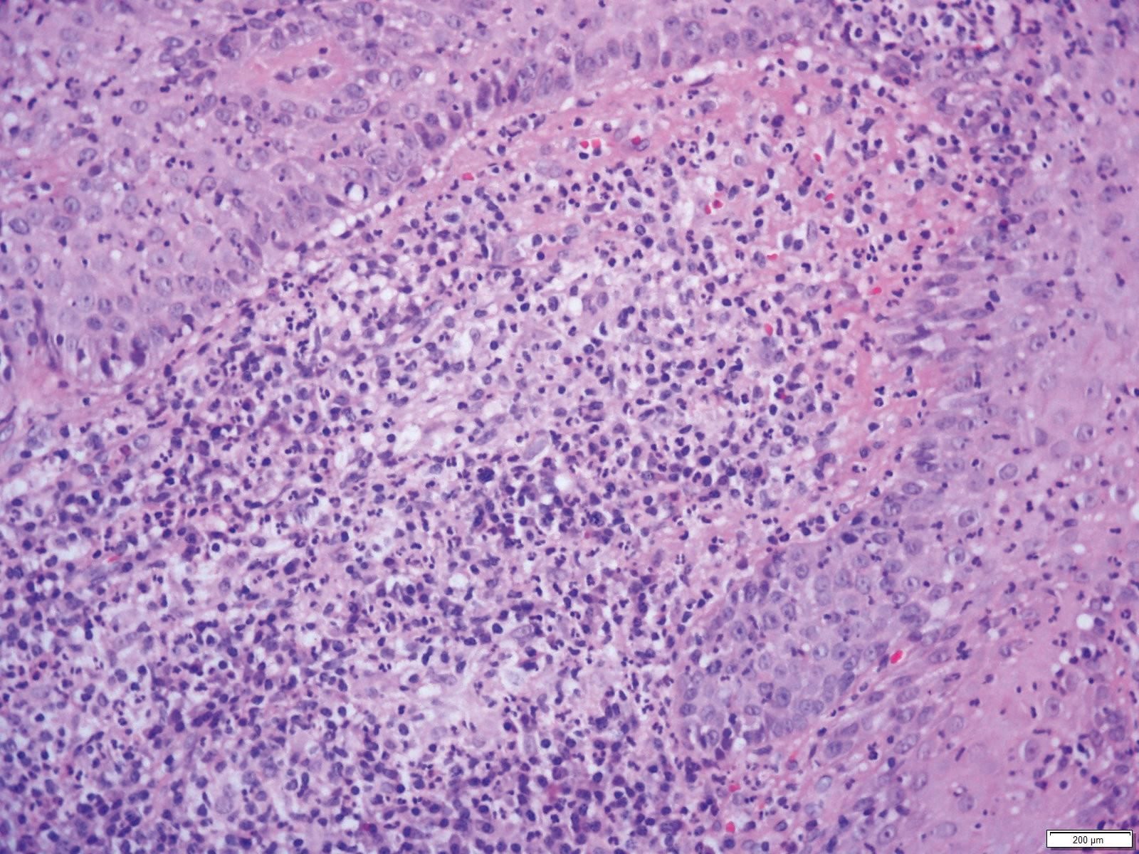 Plect PLECT or PPLECT? Granulomatous pyoderma gangrenosum in the differential ...
