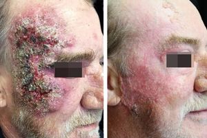 Before and after treatment. Left: extensive verrucous plaque in the right temporomalar region, with erythematous and infiltrated borders and scaly, crusted central ulcerations. Right: appearance after the established therapy