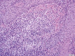 Histopathology: chronic granulomatous inflammatory process (Hematoxylin & eosin, x200)