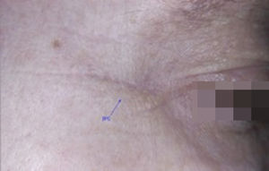 Aspect, three months after the biopsy, of the right periorbital region treated with BTXA, with a small skin-colored linear scar