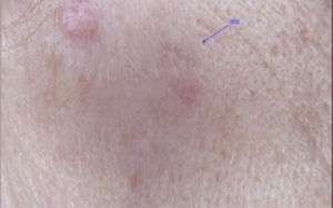 Aspect, three months after the biopsy, of the right preauricular region treated with BTXA, with a small skin-colored linear scar