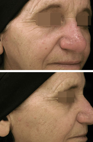 Aspect of the periorbital wrinkles at rest, before the biopsy and the injection of BTXA A and three months after B