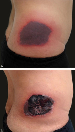 A - Ecchymosis on the right flank. B - Progression of the lesion with eschar formation