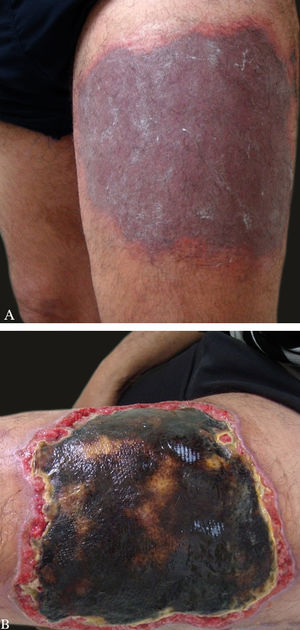 A: Ecchymosis on the left thigh. B: Progression of the lesion with eschar formation