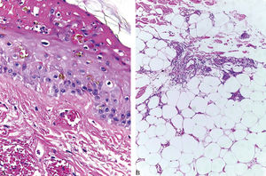 A - Necrosis of the superficial portion of the epidermis and capillary thrombosis (Hematoxylin & eosin, x40). B - Fibrin deposits in the vessel wall associated to focal intravascular thrombosis and fat necrosis (Hematoxylin & eosin, x10)