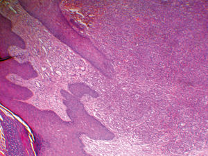 Acanthotic epidermis and dermis with a mixed inflammatory process surrounded by collagen tissue and vessel neoformation (Hematoxylin & eosin, x40)