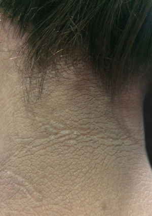 Acanthosis nigricans on the neck