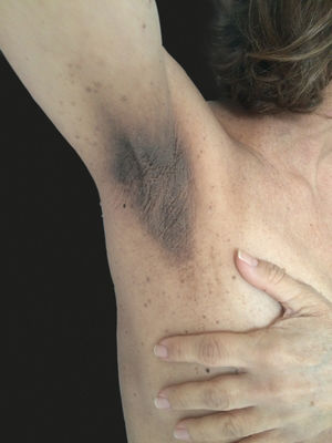 Acanthosis nigricans on the axillae