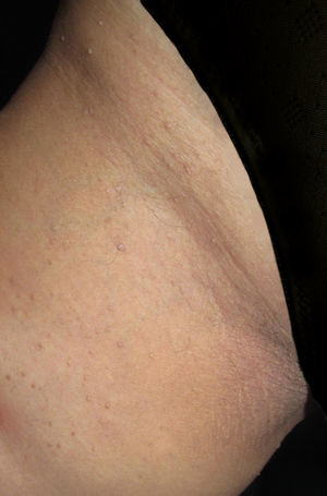 Acanthosis nigricans on the medial thigh