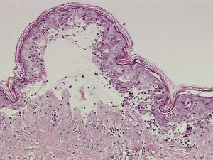 Histological examination showing necrosis of keratinocytes throughout the epidermis, and subepidermal vesiculation (Hematoxylin & eosin, x200)