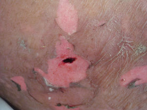 The wound on the upper arm after debridement, measuring approximately 15 x 5 mm