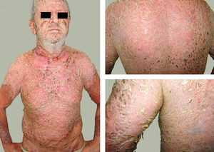 Patient with generalized vesiculobullous form evolving to erythroderma