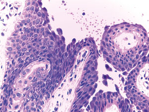 Detachment of acantholytic cells in the granular layer. Note the absence of detachment in the stratum corneum. Histopathology of FS (Hematoxylin & eosin, x400)