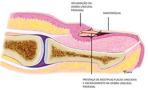 Retronychia: Longitudinal view showing multiple ingrown nail plates, xanthonychia and inflammation of the proximal nail fold. Illustration by Rodrigo Tonan