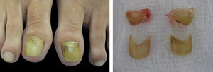 A - Onycholysis and xanthonychia of both halluces in the setting of disrupted nail growth B - The avulsed nail plate presents multiple layers