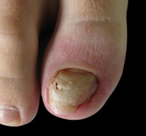 Periungual erythema, onycholysis, and mild yellow coloration of the right big toenail after local trauma