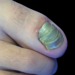 Chronic painful paronychia, xanthonychia, thickening of the proximal portion of the nail plate, and multiple generations of nail plate. Note apparent adhesion of the plate to the lateral horns
