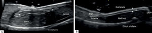 Ultrasound longitudinal view of the hallux distal phalanx dorsal aspect. A - Retronychia, showing 3 overlapping nail plates* (PNF: proximal nail fold). B - Normal nail unit in the contralateral hallux, (PNF: proximal nail fold; DNF: distal nail fold; * dorsal and ventral nail plates; + inter-plate space)