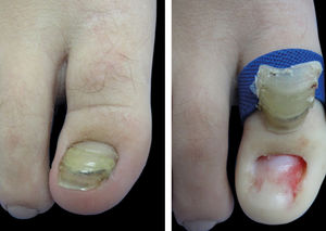 A - Preoperative view. B - After proximal avulsion of the nail