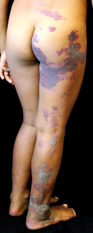 Extensive lesion with erythematous-violaceous squamous plaques with a linear pattern