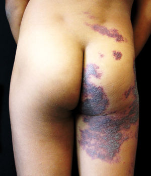 Detail of erythematous-violaceous lesion on lumbosacral and gluteal regions and posterior thigh
